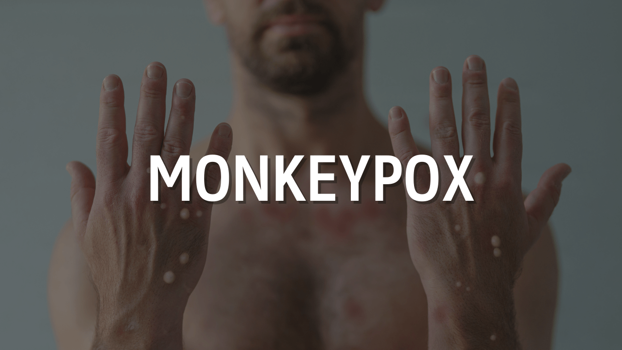 The quantity of monkeypox cases in the United States exceeds 20,000, the maximum in the planet: InfoQuest